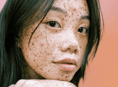 Woman with freckles and a couple of pimples looks at camera