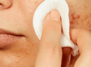 Photo of salicylic acid toner being applied