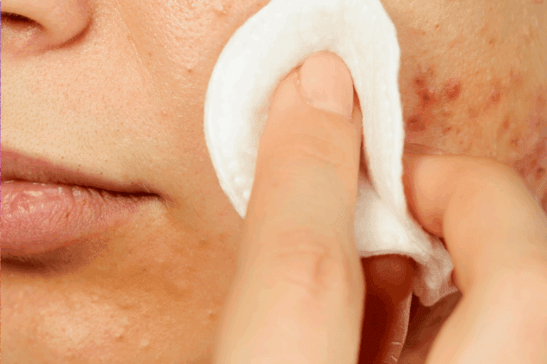 Photo of salicylic acid toner being applied