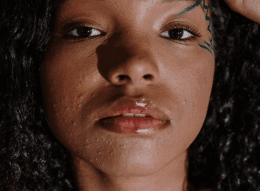 Woman with closed comedones on face