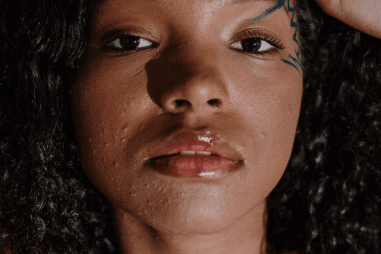 Woman with closed comedones on face