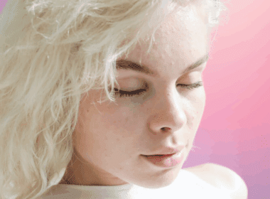 Photo of a woman with clogged pores