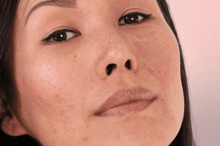 Woman with mild acne