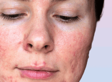 Woman with pustules from rosacea