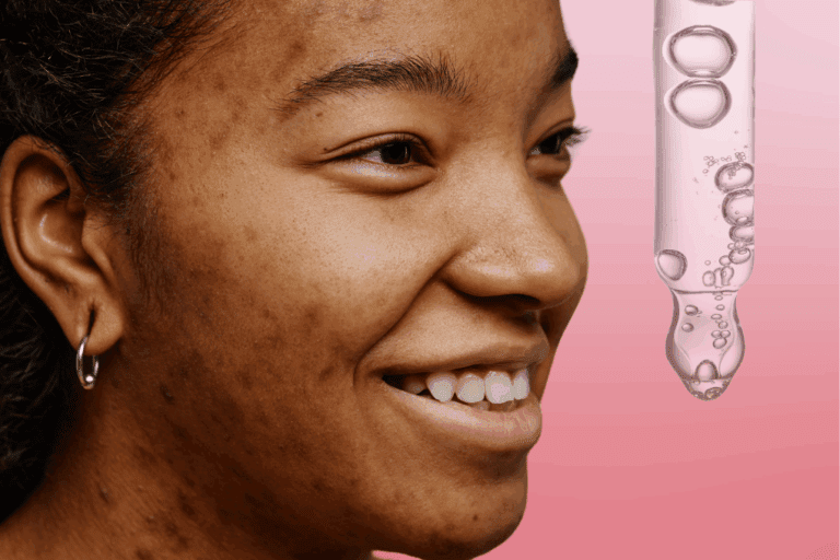 Woman with hyperpigmentation and a serum dropper