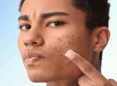 Man with acne about to apply a cream product to face